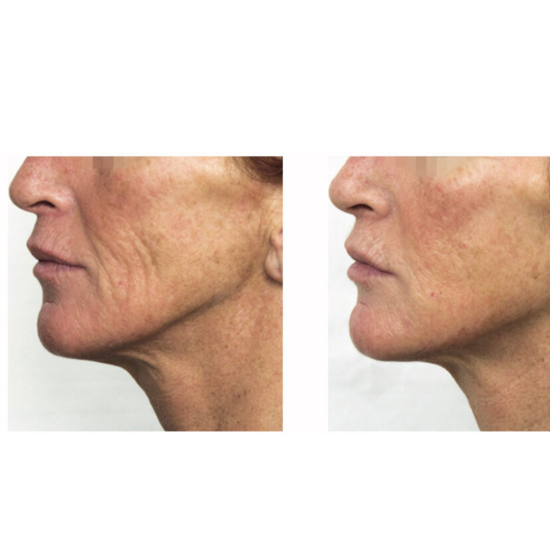 PRX-T33 medical peeling. - Image 5