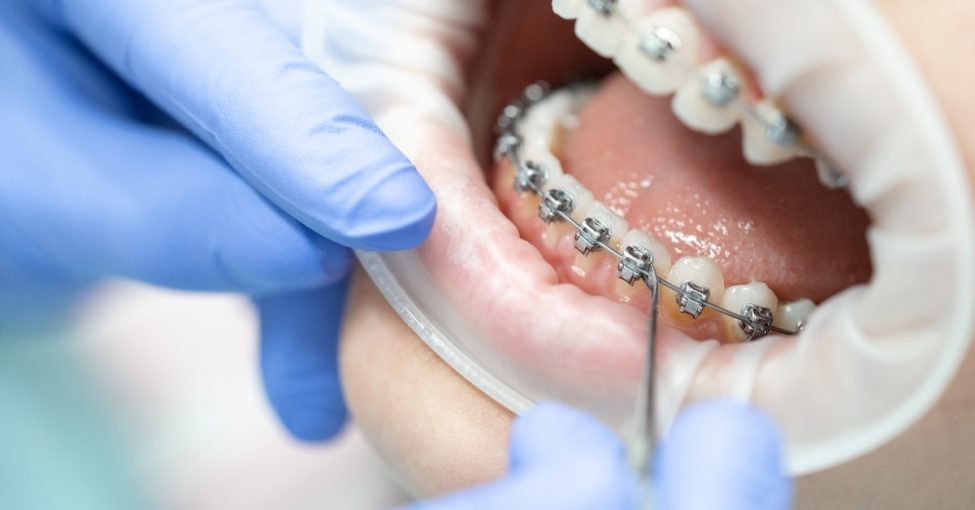 Dental patient with orthodontic braces being assessed
