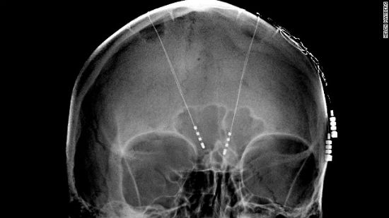 deep brain simulation