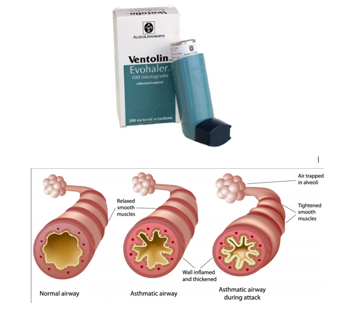 Asthma - Better treatment for patients and better for the environment