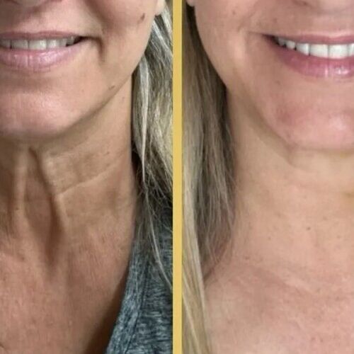 What is Platysma Botox?