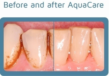 AQUACARE DENTAL AIR POLISHING - THE GOLD STANDARD STAIN REMOVAL TREATMENT