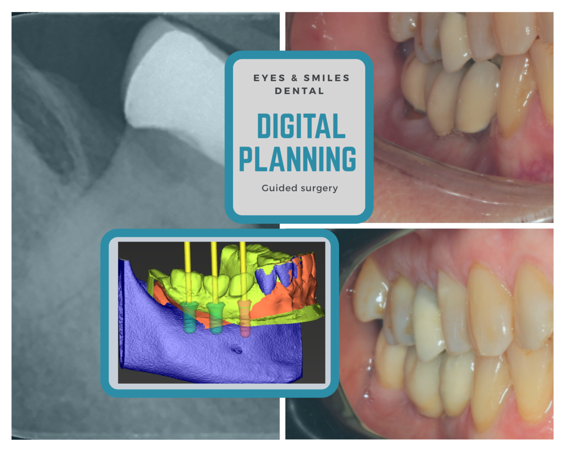 Some of the Important Dental Implant Problems and Its Complications