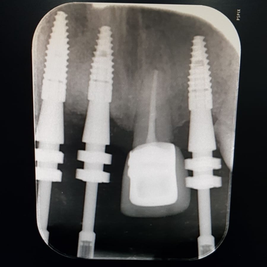 Some of the Important Dental Implant Problems and Its Complications