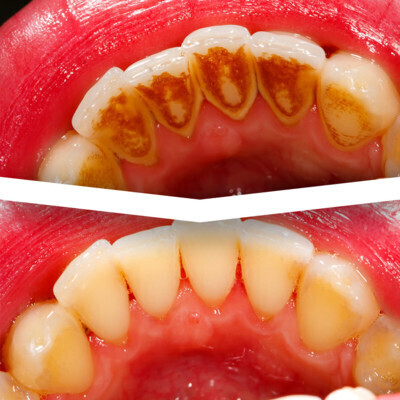 Hygienist Services and Teeth Stain Removal At Eyes & Smiles Dental Clinic in Finchley North London N11, Healthy gums, swollen gums, bleeding gums, smoking stains, tea stains, coffee stains, air polish, scale and polish, aquacare, floss, electric toothbrush, gum treatment, periodontal treatment,