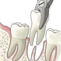 Safe and Well-planned Extractions and Oral Surgery At Eyes & Smiles Dental Clinic in Finchley  North London N11, oral surgery, extractions, root removal, cyst removal, apicectomy, bone grafting, socket preservation, infection removal, crown lengthening, root sectioning, wisdom tooth removal, hemisection