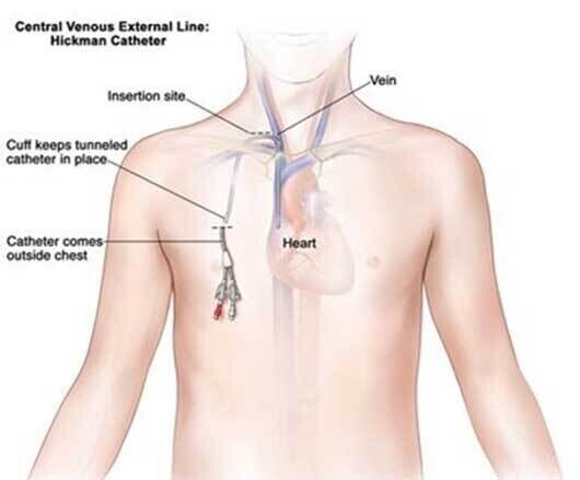 tesio catheter