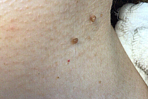 Skin-Tag Removal