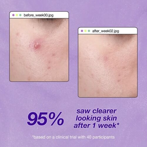 Breakout Clearing Liquid Peel