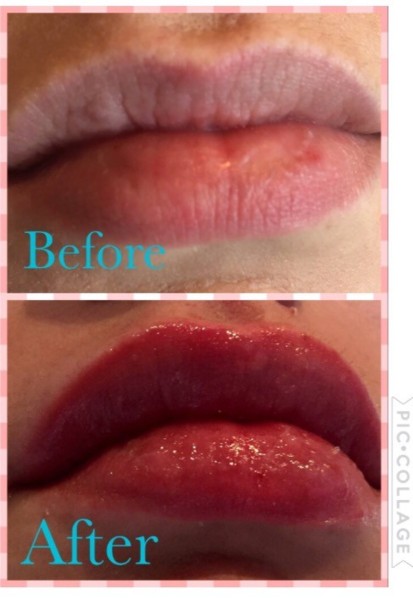 Botox & Fillers