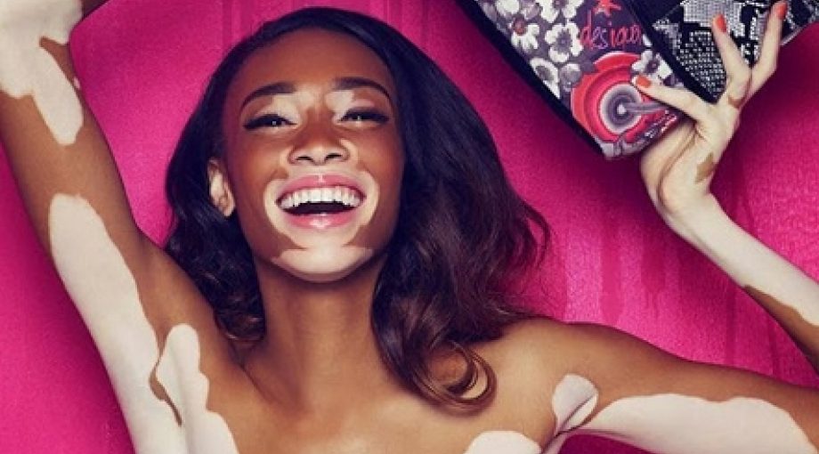 Winnie harlow chantelle brown young vitiligo 335