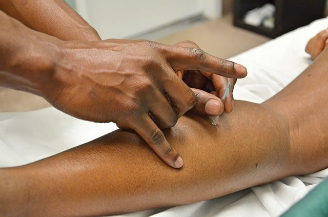 acupuncture acupuncteur