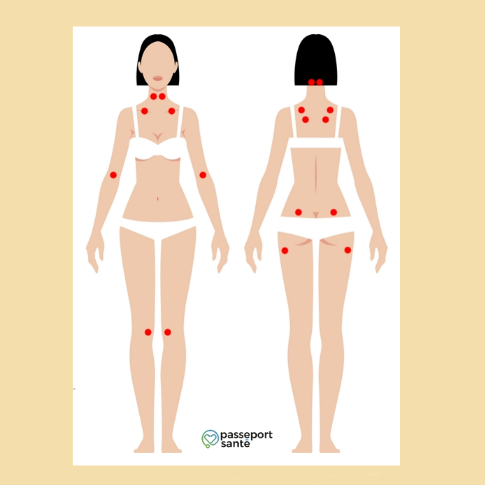 Blog Doctoome | Fibromyalgie : Fabulation ou fait réel ? - points de Yunus