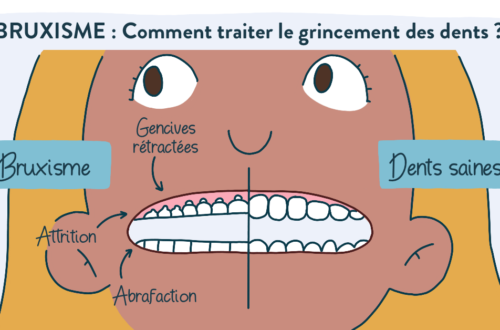 bruxisme : causes et traitement : éviter le grincement des dents