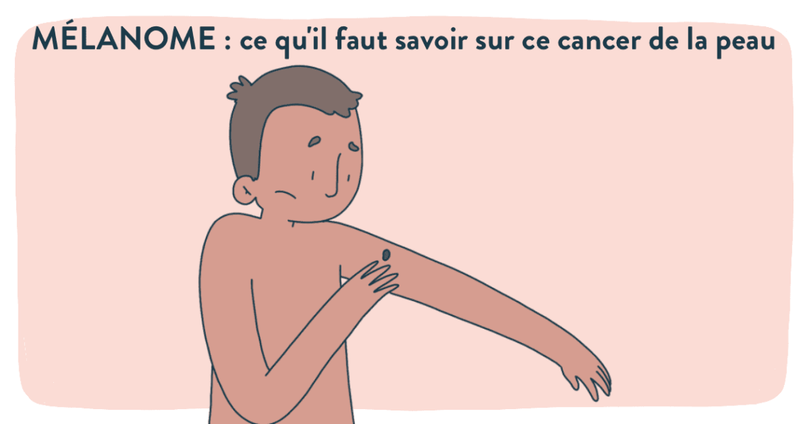 mélanome : ce qu'il faut savoir sur ce cancer de la peau