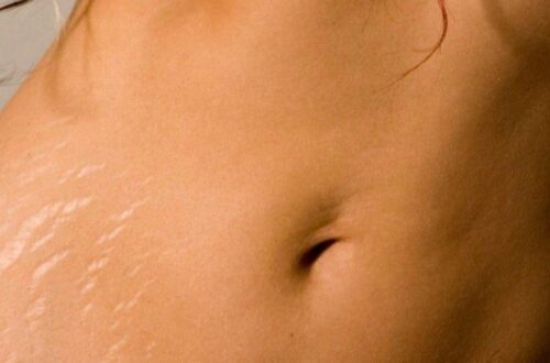 Les vergetures - s’en débarrasser ou vivre avec(1)