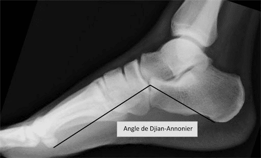 semelles-orthopediques-angle