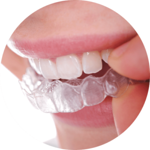 alignement des dents