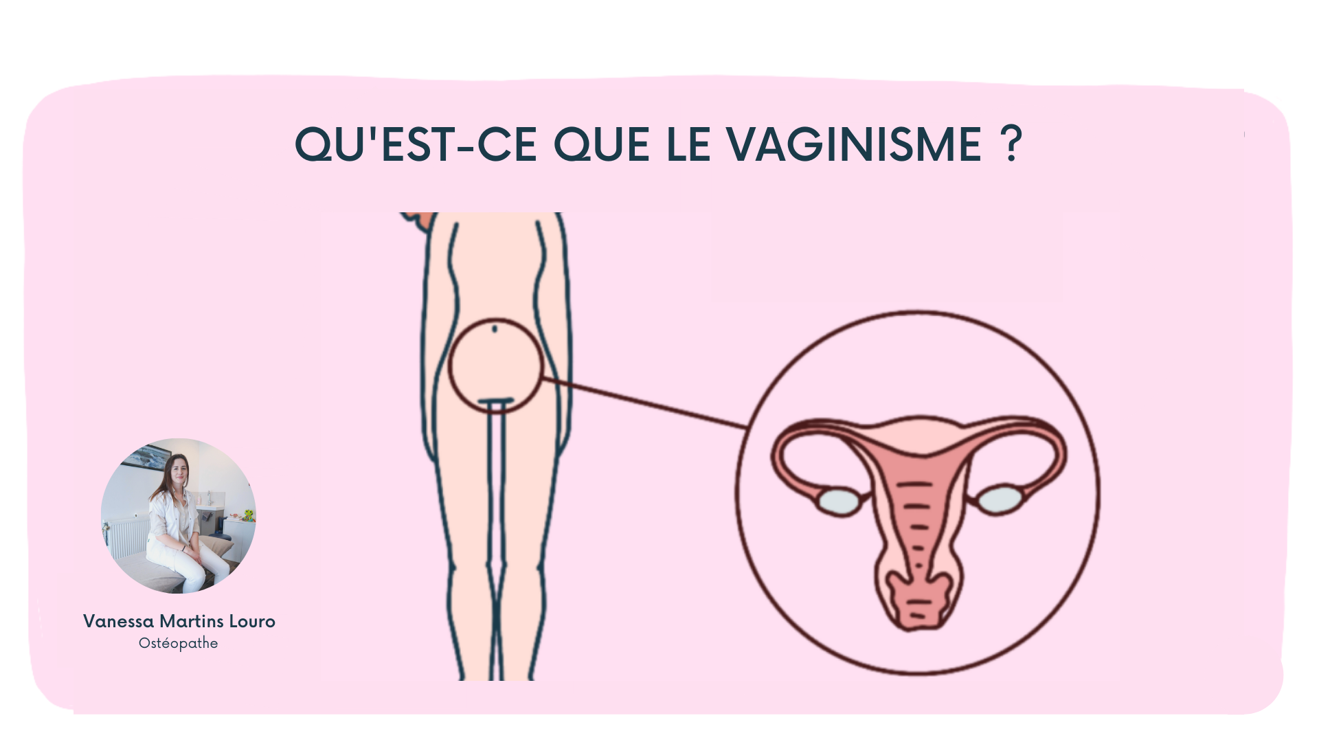Tout savoir sur le vaginisme