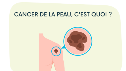 Cancer de la peau : types, symptômes et traitements