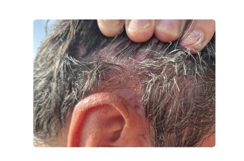 eczema du cuir chevelu