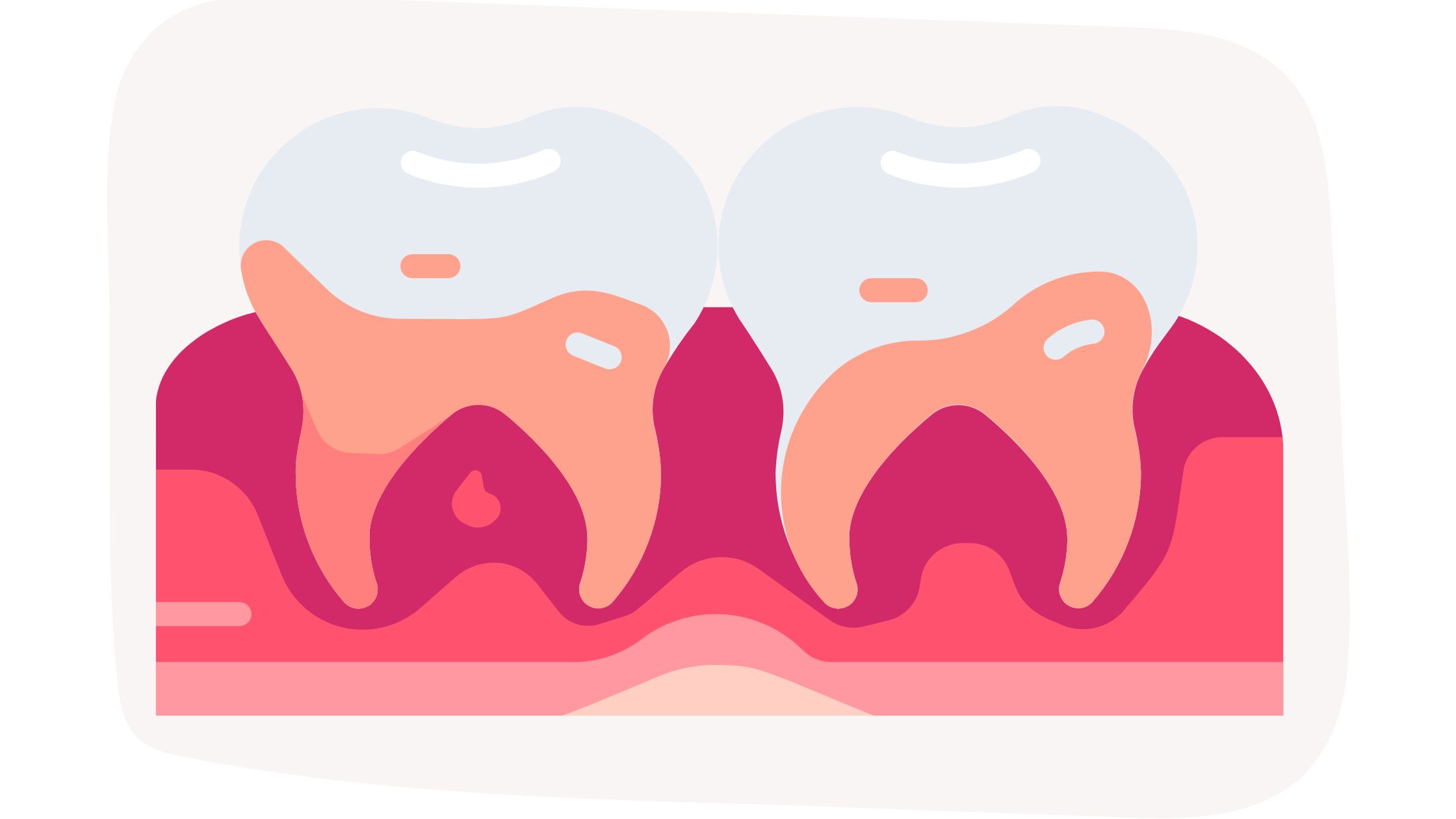 Comprendre les maladies parodontales