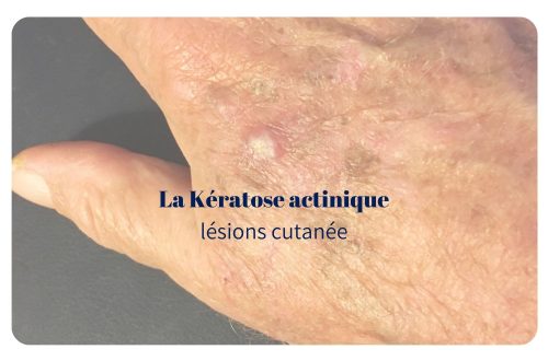 La kératose actinique est une lésion précancéreuse de la peau due à une exposition aux rayons UV.