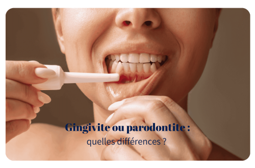 La gingivite et la parodontite sont deux pathologies bucco-dentaires qui affectent les gencives, mais avec des degrés de gravité et des conséquences très différentes. Si elles ne sont pas traitées rapidement, elles peuvent entraîner des complications importantes, notamment la perte des dents.