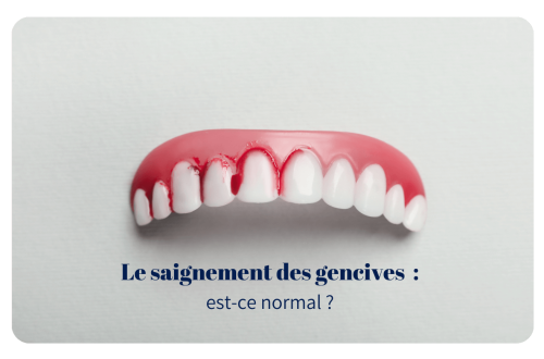 Le saignement des gencives est un symptôme courant qui peut parfois passer inaperçu. Il survient généralement lors du brossage des dents ou de l'utilisation du fil dentaire. Bien que cela puisse sembler anodin, des gencives qui saignent fréquemment ne doivent pas être négligées.