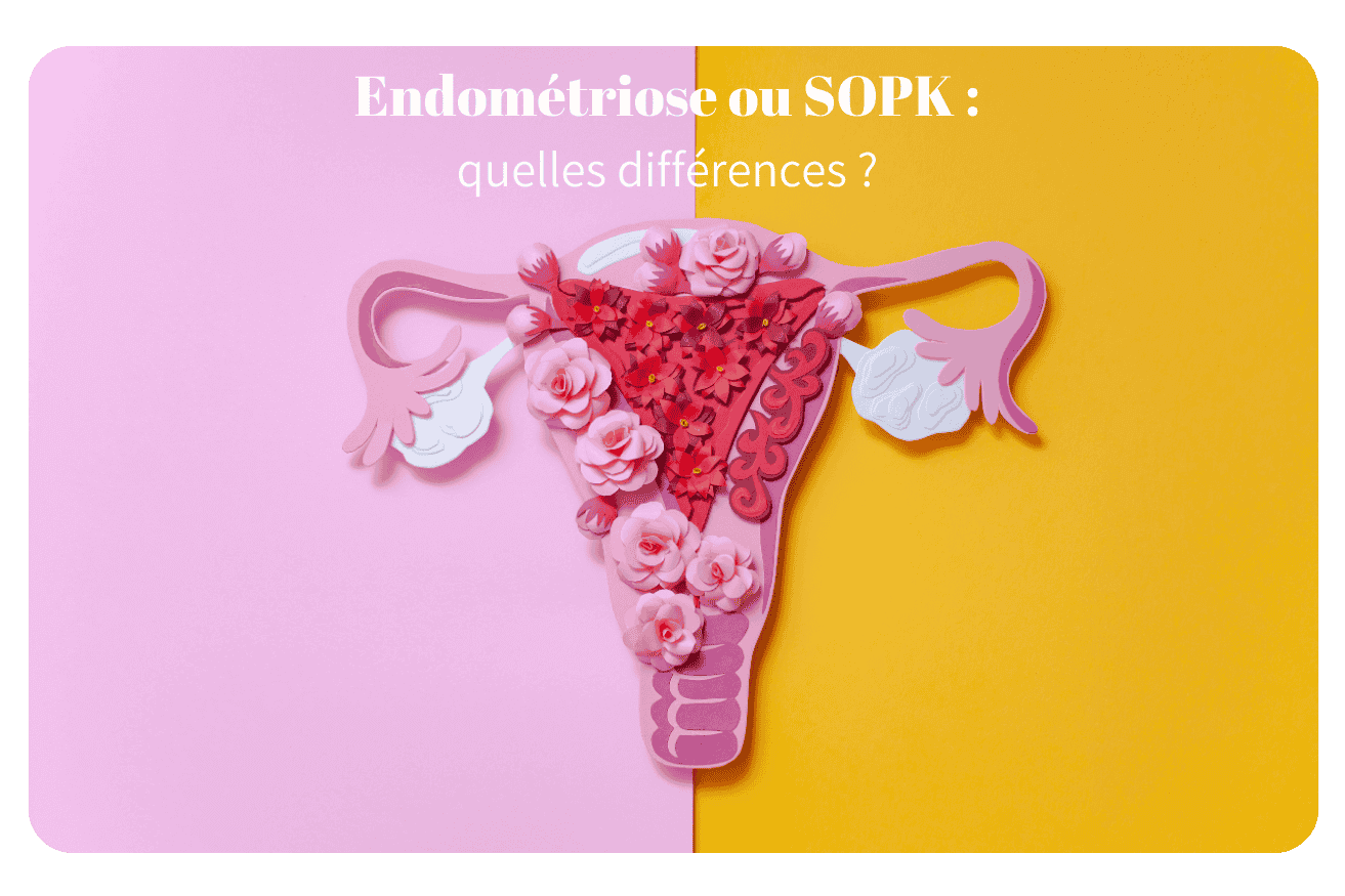 Les symptômes clés pour différencier endométriose ou sopk