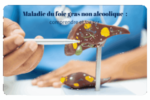 La NASH, ou stéatohépatite non alcoolique, représente un stade avancé de la maladie du foie gras non alcoolique (NAFLD). Cette pathologie se caractérise par une accumulation excessive de graisse dans le foie, associée à une inflammation et potentiellement à une fibrose, chez des personnes consommant peu ou pas d'alcool.