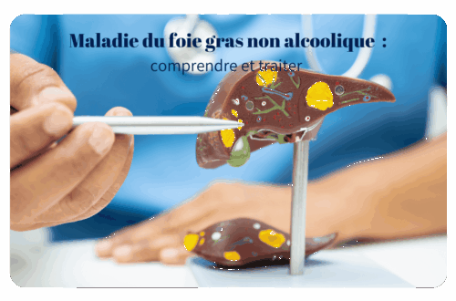 La NASH, ou stéatohépatite non alcoolique, représente un stade avancé de la maladie du foie gras non alcoolique (NAFLD). Cette pathologie se caractérise par une accumulation excessive de graisse dans le foie, associée à une inflammation et potentiellement à une fibrose, chez des personnes consommant peu ou pas d'alcool.