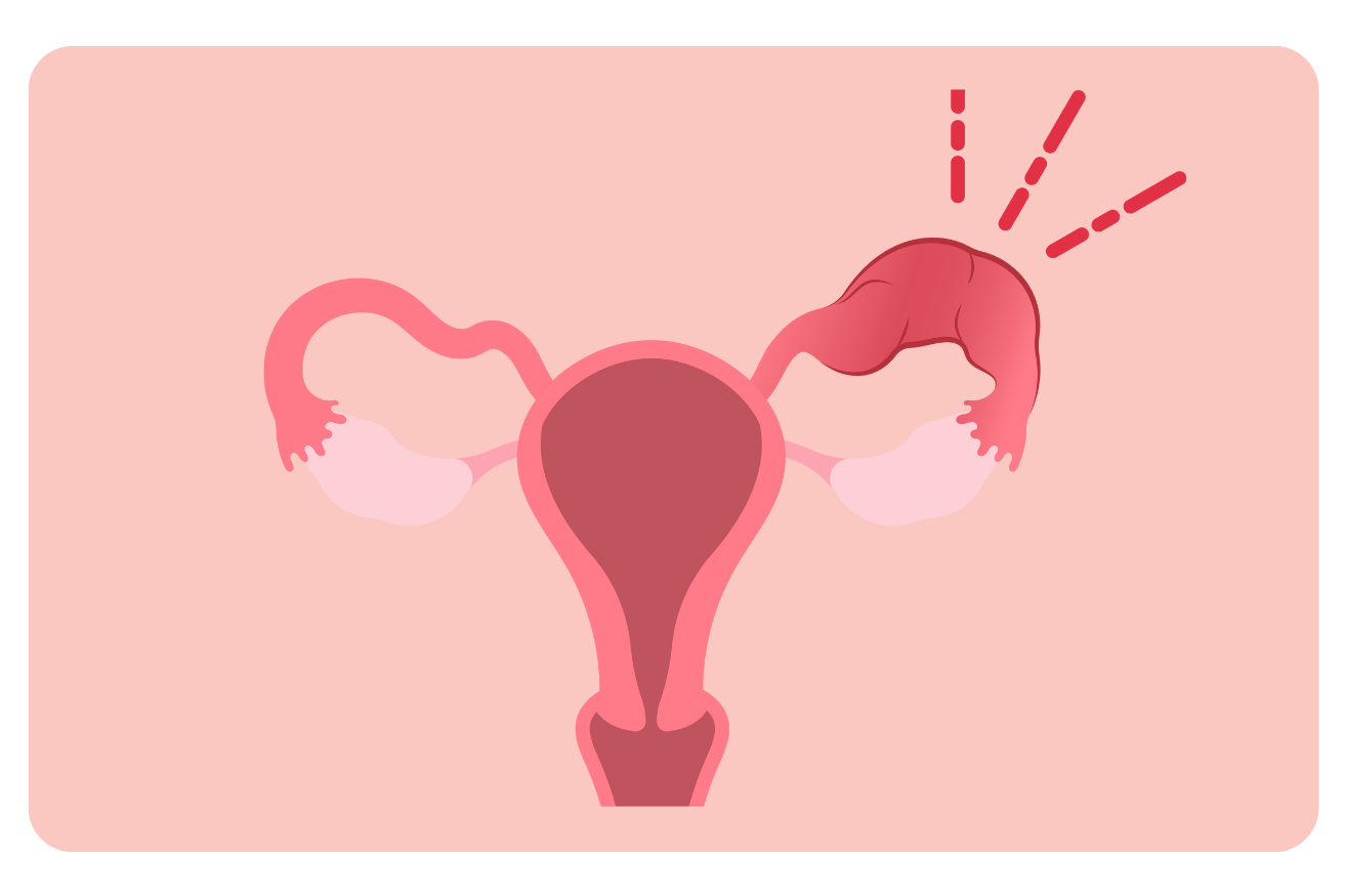 Infection pelvienne (PID) : Symptômes, Causes et Traitements efficaces