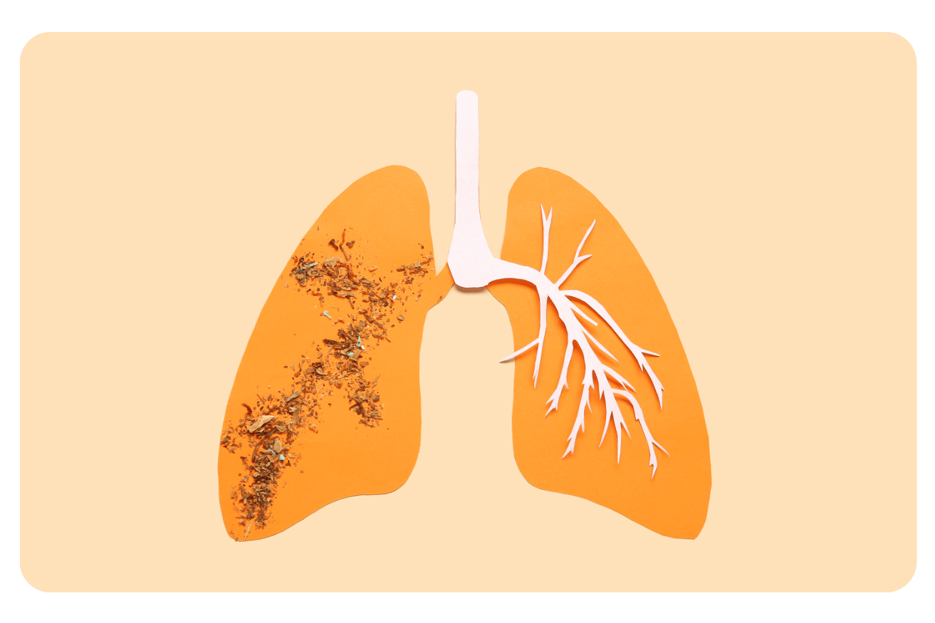 Fibrose pulmonaire : causes, symptômes et traitements