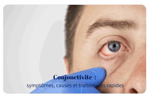 La conjonctivite est une affection fréquente de l’œil, bénigne dans la majorité des cas, mais parfois contagieuse ou révélatrice d’un trouble sous-jacent. Cette inflammation de la conjonctive — la fine membrane qui tapisse l’intérieur des paupières et le blanc de l’œil — entraîne rougeur, gêne et écoulements. Dans cet article, faisons le point sur les symptômes, les causes, les traitements et les bons réflexes à adopter.