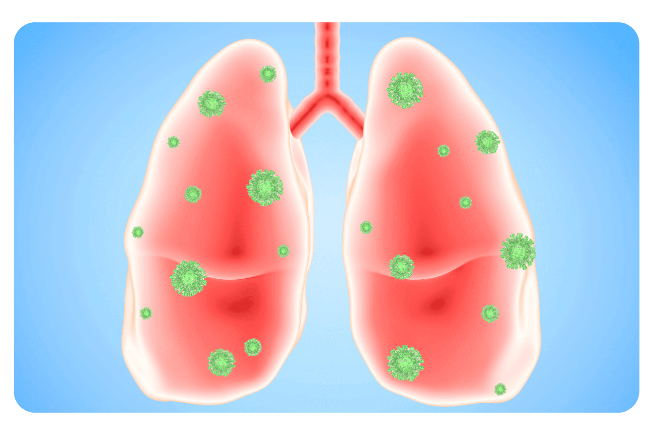 Maladies respiratoires infectieuses : Causes, symptômes et traitements