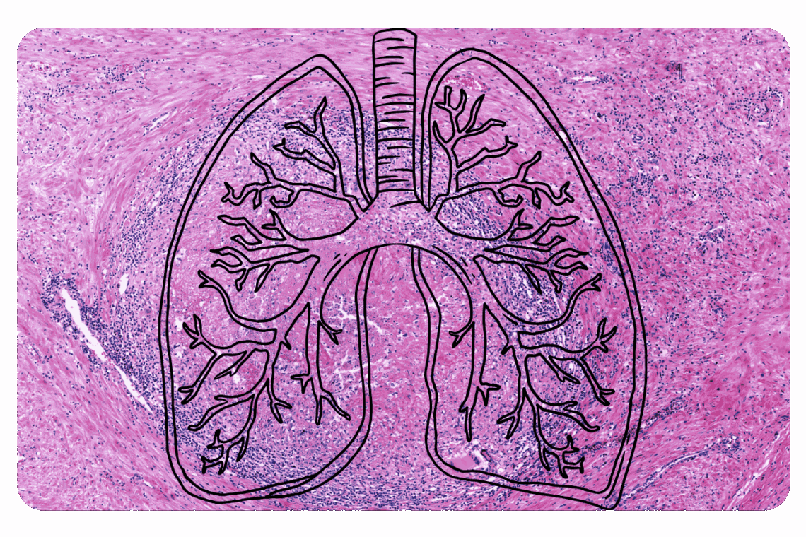 granulomes aux poumons dans le cadre de maladies respiratoires