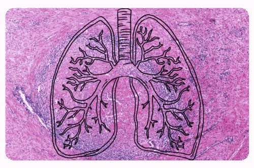 granulomes aux poumons dans le cadre de maladies respiratoires
