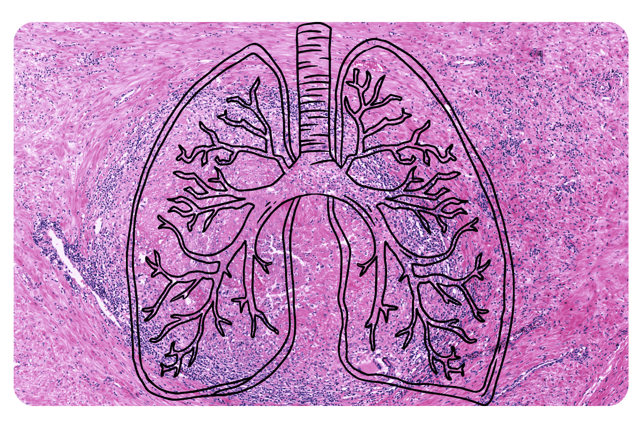 Maladies pulmonaires interstitielles : causes, symptômes et traitements