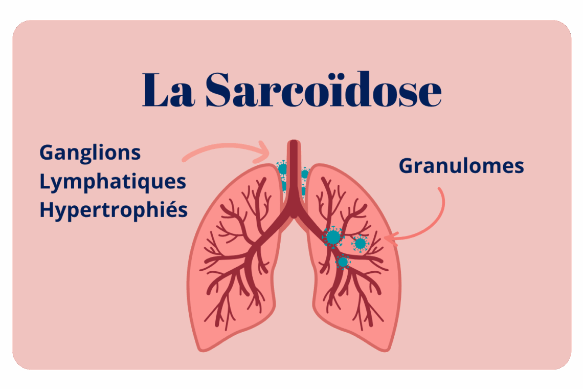 la sarcoidose