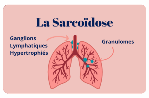la sarcoidose