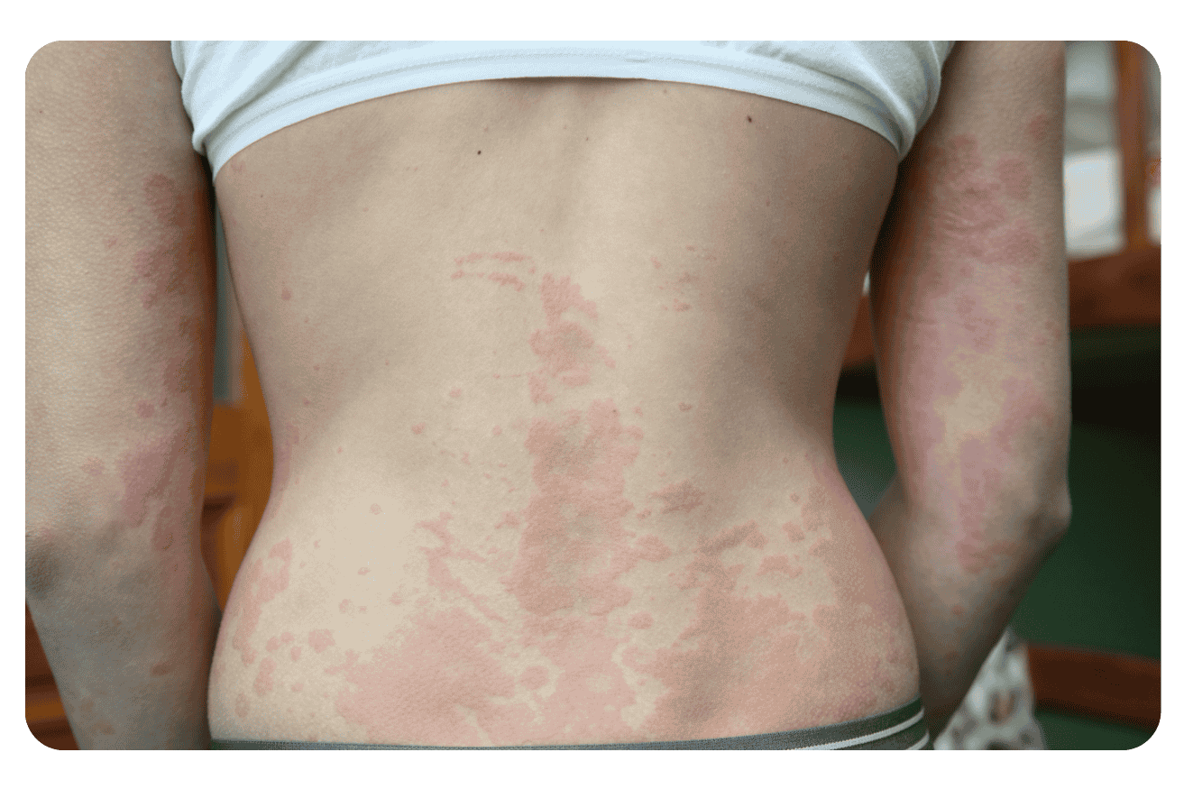 Urticaire : Traitements efficaces et solutions de soulagement rapide