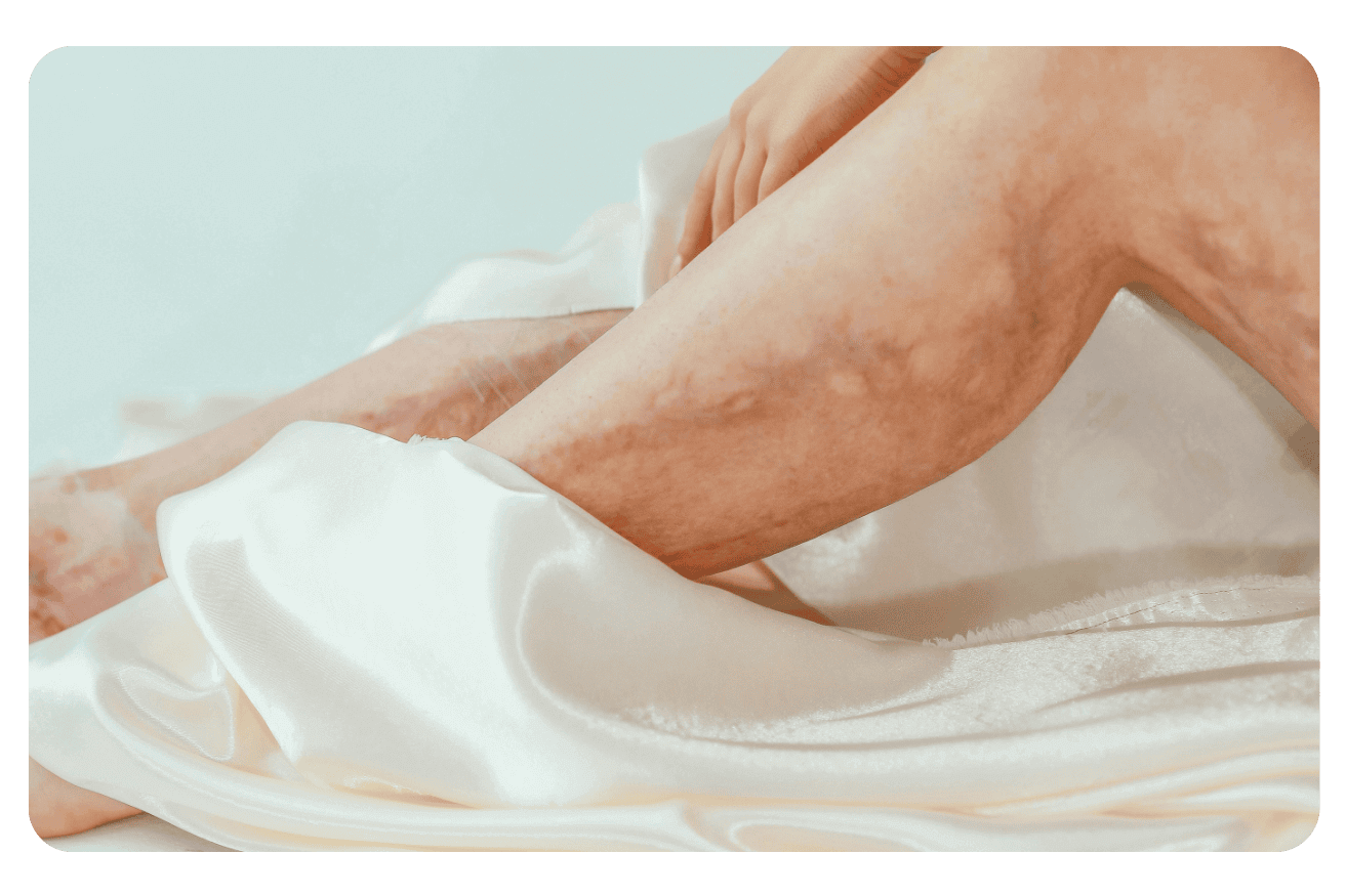 Les types d&rsquo;affections cutanées : guide complet des dermatoses