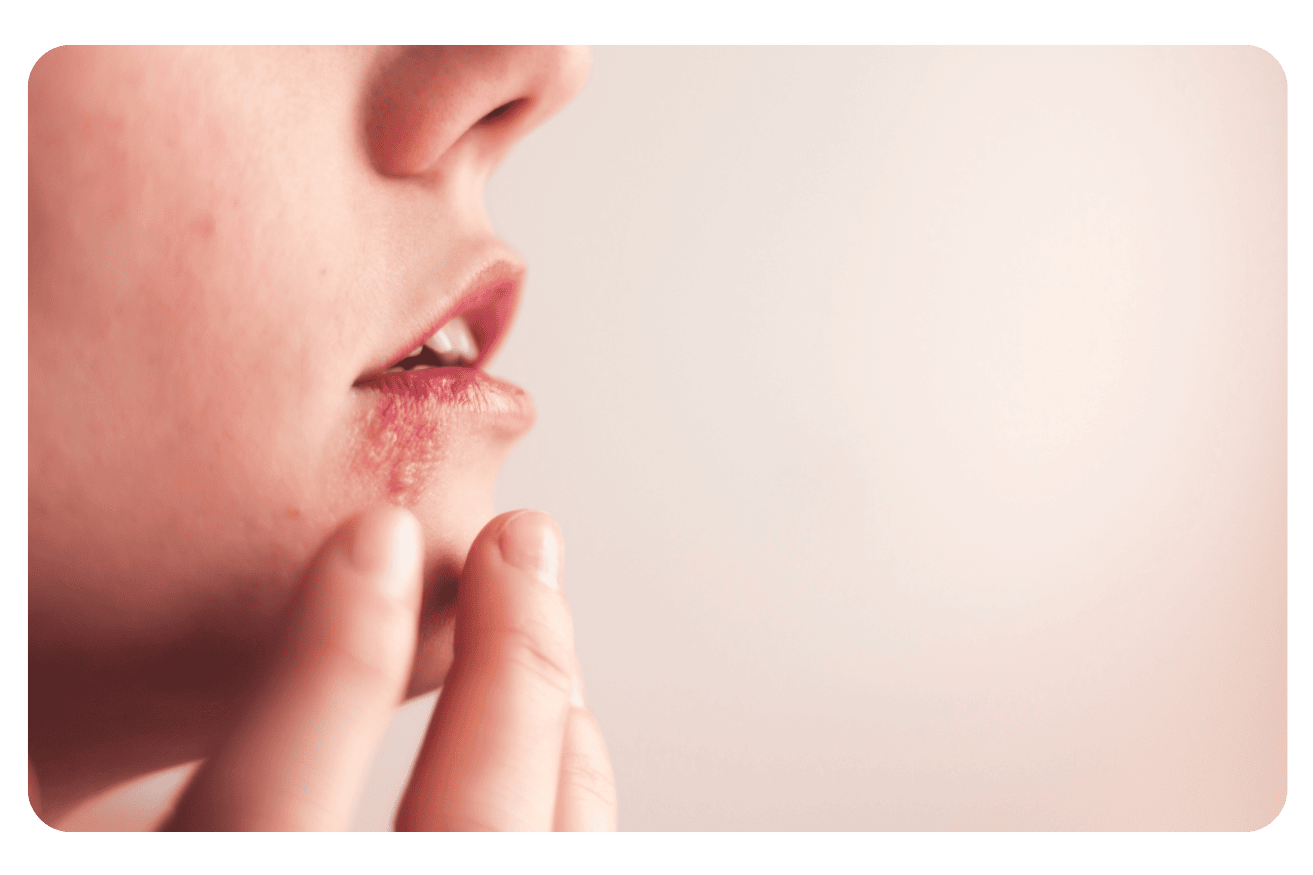 Dermatoses infectieuses : Causes, symptômes et traitements efficaces