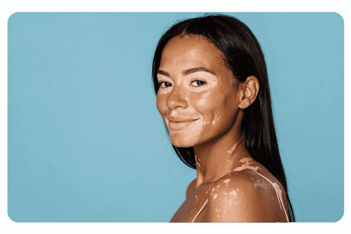 Vitiligo
