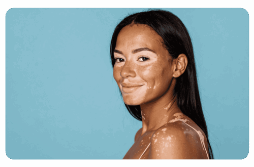Vitiligo