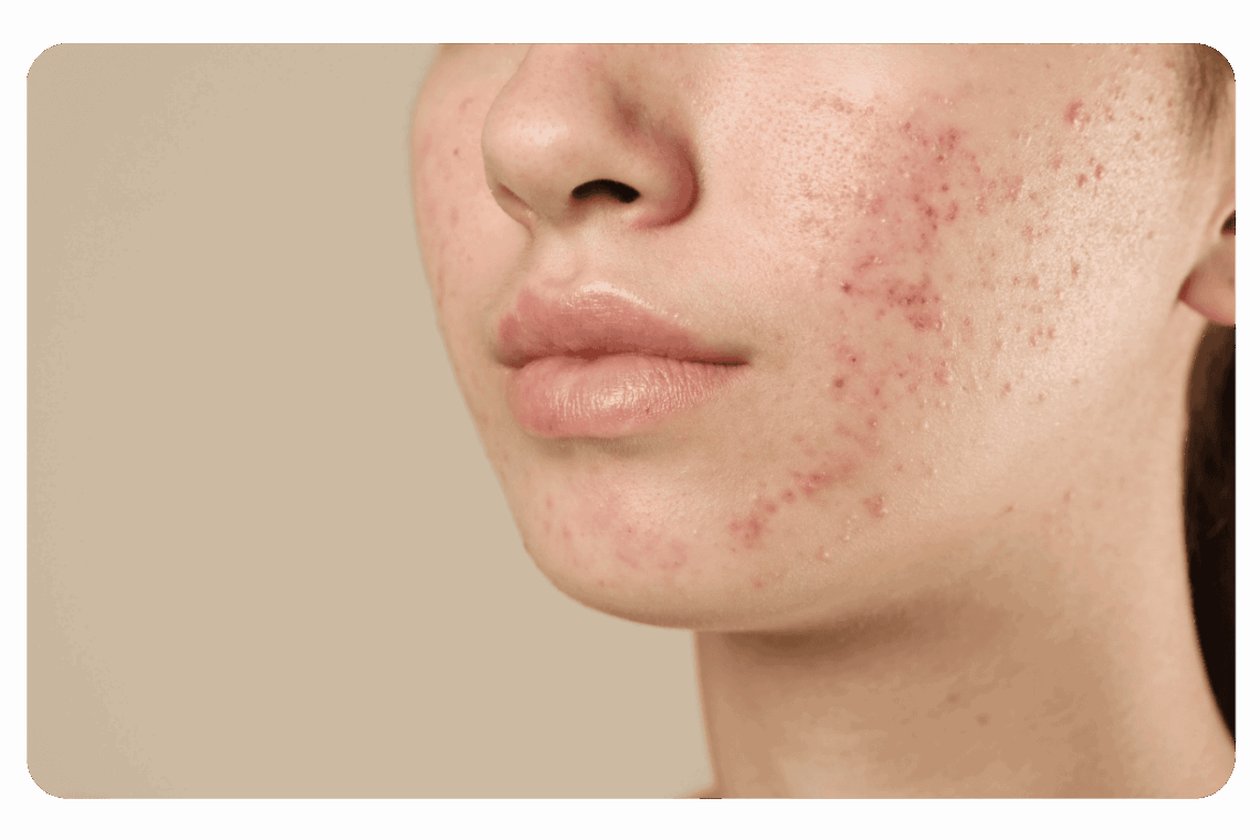 acné