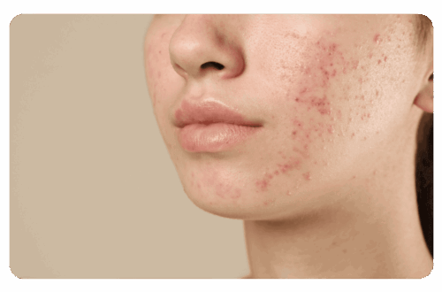 acné