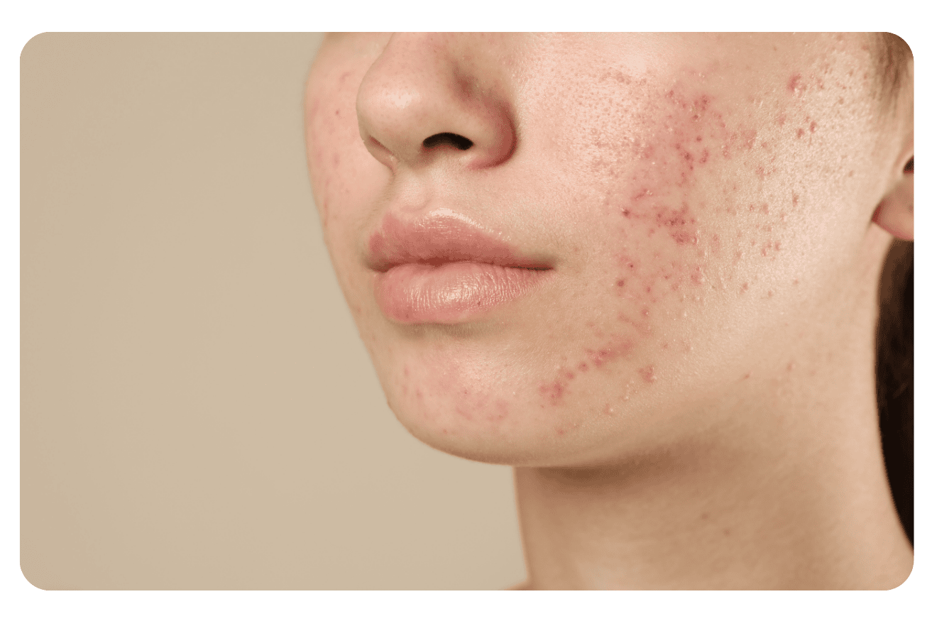 Traitement de l&rsquo;acné : Solutions efficaces pour tous les types de peau