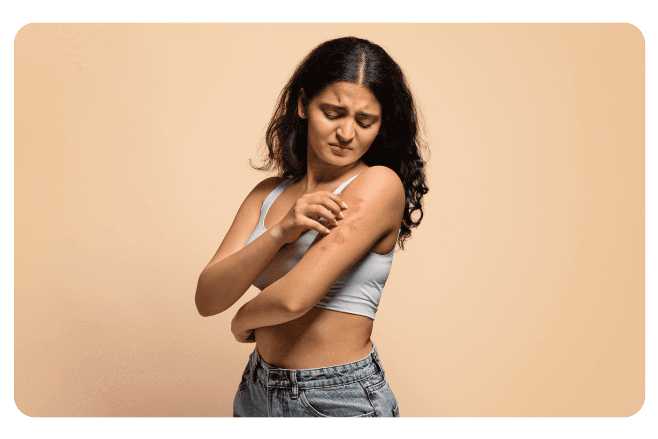 Psoriasis : Traitements efficaces et solutions naturelles pour soulager